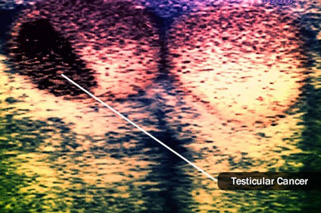With other types of cancer, doctors often test a tumor sample for cancer.