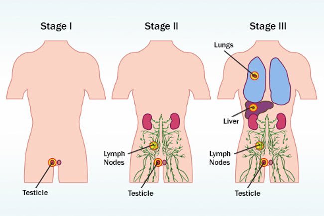 The stage of your cancer will be based on the size of the tumor and how far it's spread.