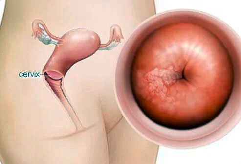 A watery or sticky vaginal discharge or leak will continue for approximately 20-25 days after cryosurgery.