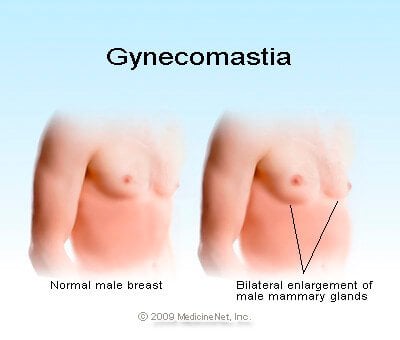 Picture of male on the left with no gynecomastia and the male on the right with gynecomastia