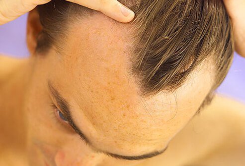 Male Pattern Baldness