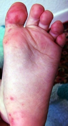 Picture of characteristic rash and blisters of hand foot and mouth disease