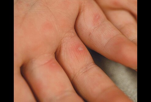 Hand Foot and Mouth Disease