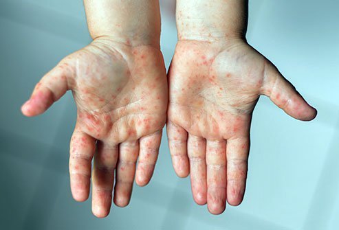 Hand, foot, and mouth disease