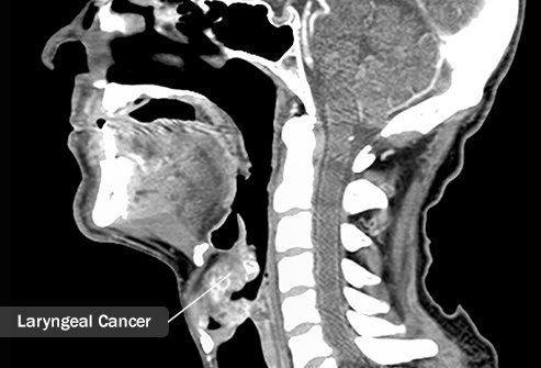 Alcohol and tobacco abuse add to the risk of laryngeal cancer.