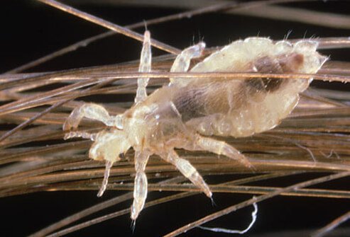 Head lice, though common, still make most parents, teachers, and health-care workers uneasy.