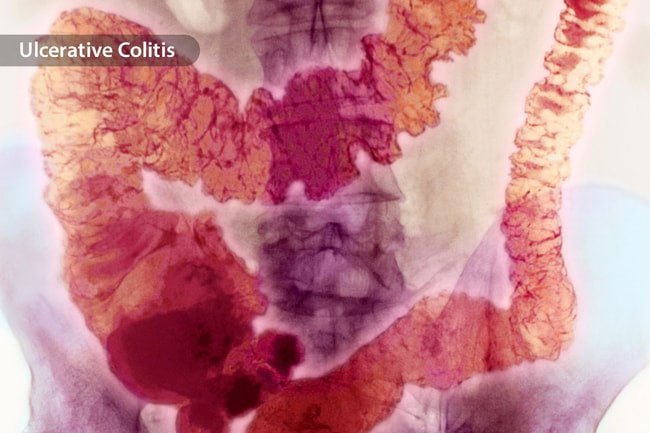 The gut biome of people who have bowel disorders is different than that of healthy people.