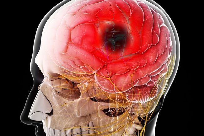 Replacing less healthy fats with olive oil in your recipes may lower your chance of getting a stroke by more than 40%.