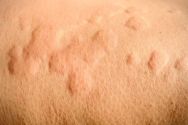 People who have a latex allergy may be allergic to pineapple.