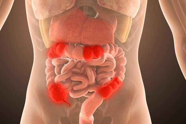 If you have a digestive condition like Crohn's or colitis, the list of what not to eat during a flare can be long.