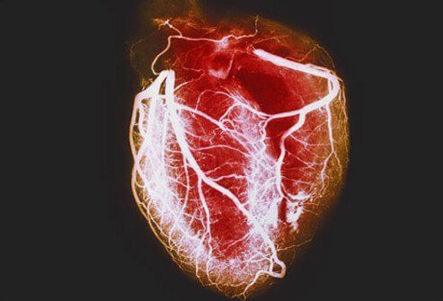 Coronary artery disease is a common type of heart disease and the leading cause of heart attacks.