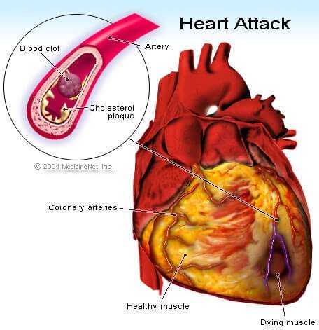 Heart Attack illustration - Myocardial Infarction