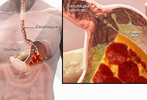 The Lower Esophageal Sphincter