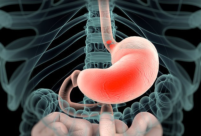 Heartburn happens when your esophagus becomes irritated due to stomach acid. You can stop heartburn instantly with over-the-counter medications like antacids. 