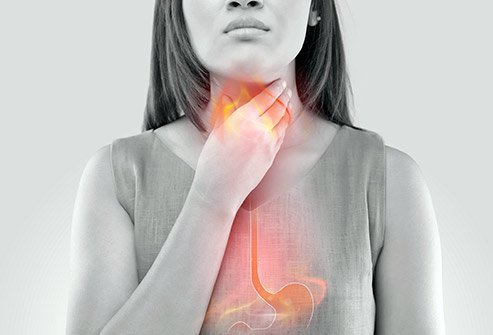 Heartburn is an uncomfortable burning feeling in the chest and throat. Get rid of heartburn fast with medications, home care and alternative therapies.