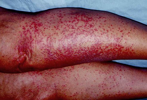 The sweat glands are blocked and the inflammation causes a red color to the rash known as rubra.
