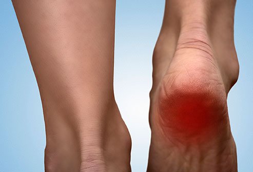 Heel pain has a variety of causes but plantar fasciitis is the most common one. 