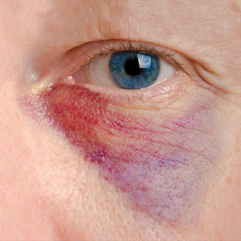 A close-up of an under eye hematoma.