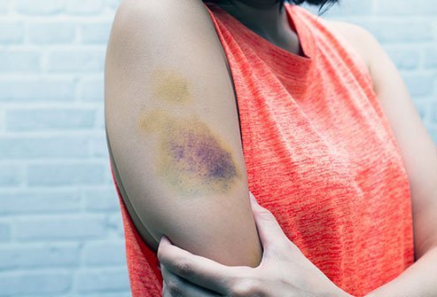 A bruise may take up to 2-3 weeks to fade away
