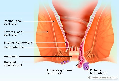 Picture of Hemorrhoid