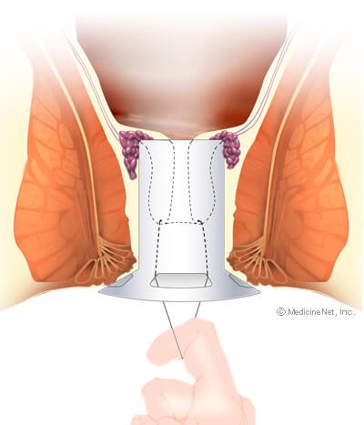 Picture of Bringing Expanded Hemorrhoidal Supporting Tissue into the Hollow Tube by pulling On Suture