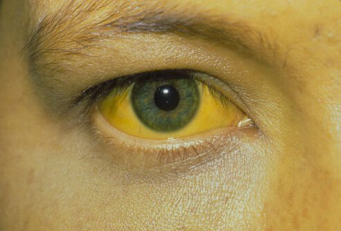Symptoms of Hepatitis
