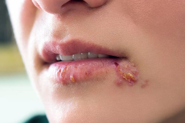 Herpes simplex virus 1 (HSV-1) and simplex virus 2 (HSV-2) are the two types of herpes virus and will look different as they develop during five stages.