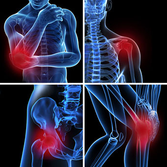 Three-dimensional images illustrate where bursitis can occur on the body.