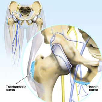 An illustration of hip bursitis shows the trochanteric bursa and the ischial bursa.