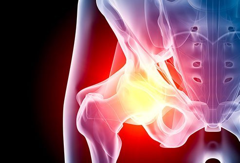 Avascular necrosis (AVN) of the hip