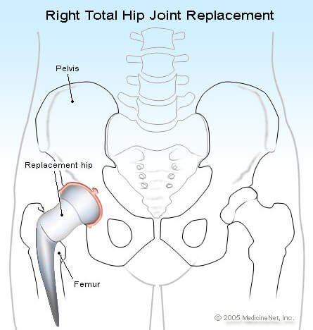 Picture of a total hip replacement