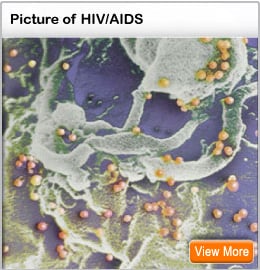Picture of the HIV/AIDS virus