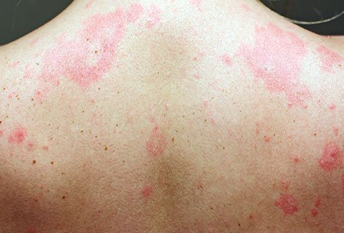 Hives are raised, itchy skin welts. A rash is an inflammation or discoloration of the skin. Hives and rashes look similar.