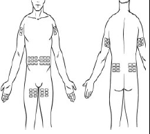 HIZENTRA, Immune Globulin Subcutaneous (Human) Figure 2 Illustration