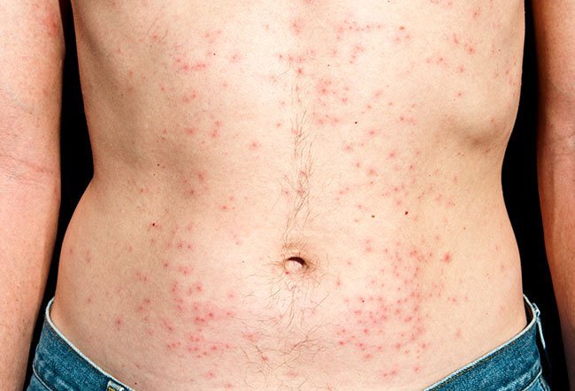 Hot tub folliculitis, also called jacuzzi folliculitis or spa pool folliculitis