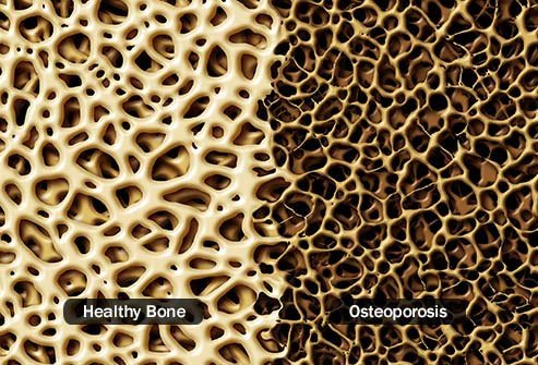 Drinking affects your bones and muscles.