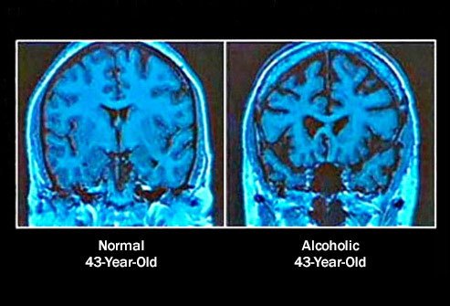 A Smaller Brain in Alcoholic