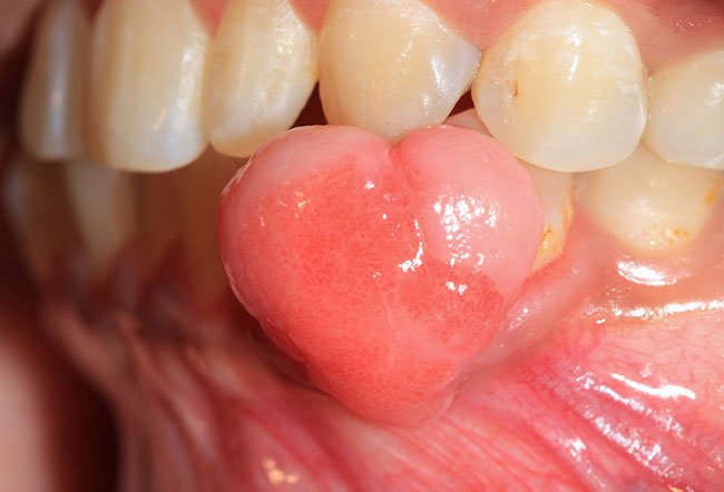 The treatment of oral lesions involves the following steps: