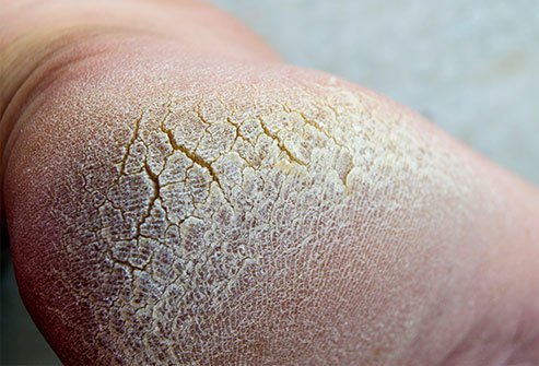 Your body takes water from all over to get rid of extra blood sugar.