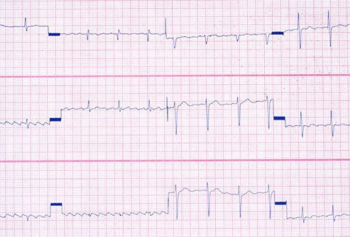 The hormones that help raise your blood sugar when it is too low can also spike your heart rate and make it feel like it skips a beat.