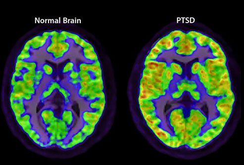 PTSD causes an overactive amygdala.