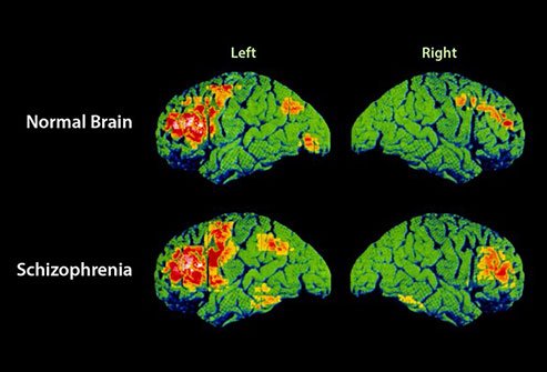 Schizophrenia causes a loss of gray and white matter in the brain.