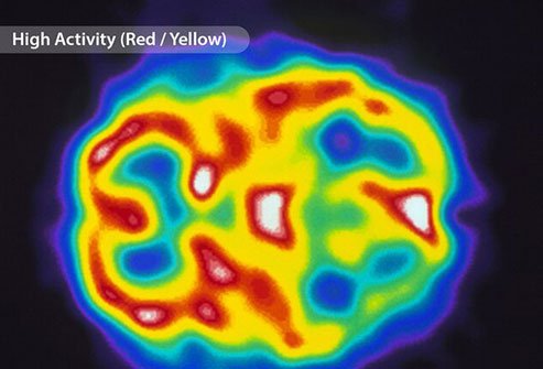 People who have migraines may react to triggers like stress and bright lights.