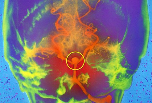 A brain aneurysm may bulge or rupture causing seizures, nausea, or worse.