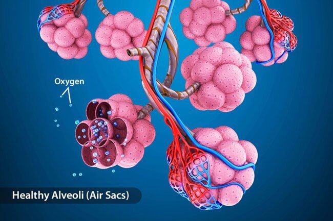 In acute respiratory distress syndrome (ARDS), your COVID-19 pneumonia gets worse quickly, and your body's response can damage your lungs more.