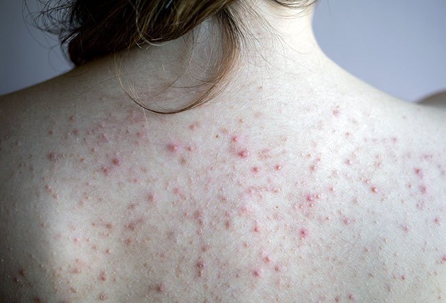 Painful, deep cystic and nodular acne pimples tend to be difficult to treat on your own. You will need a doctor to treat this condition.