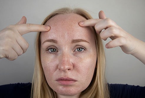 Keratosis pilaris is a condition that causes white or red bumps on the skin. You get rid of keratosis pilaris by moisturizing, exfoliating and using laser treatments.