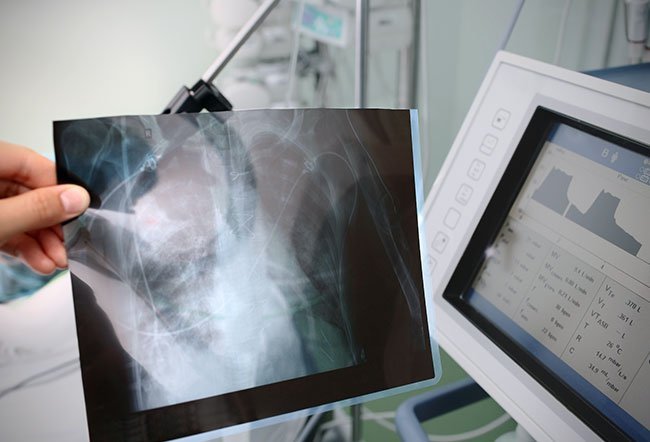 X-Ray of atelectasis