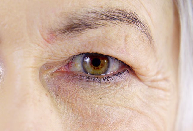 how do you fix droopy eyelids