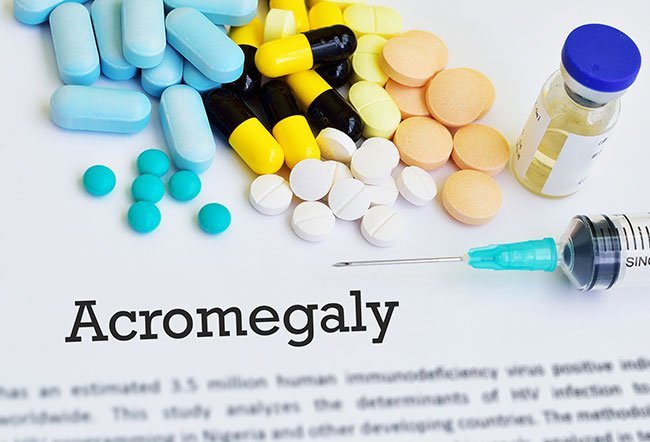 Acromegaly is a rare endocrinological disorder; only three to four cases are diagnosed per million people each year.